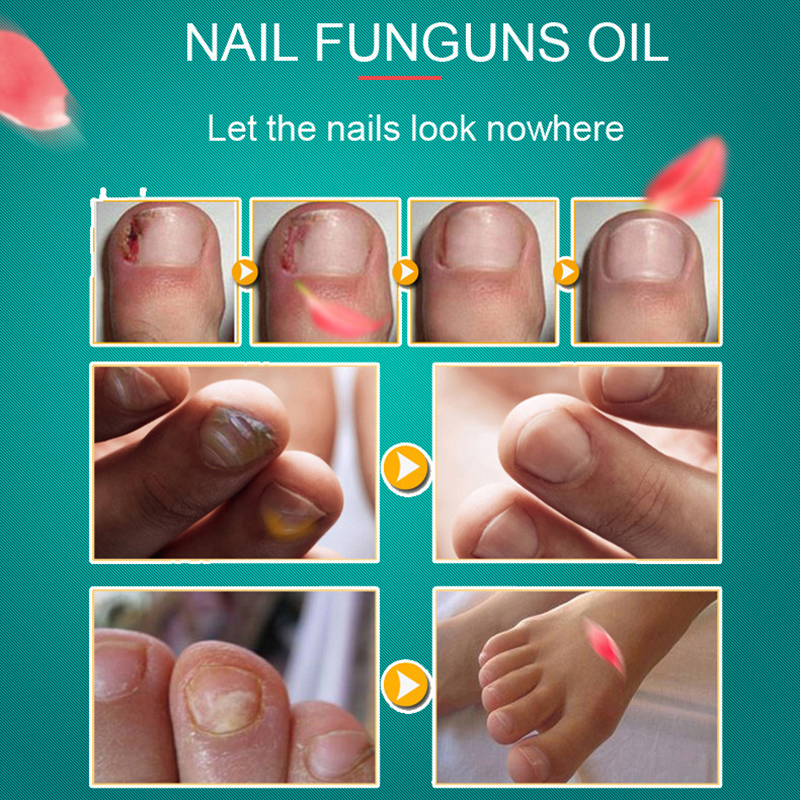 10ML-Fungal-Nail-Treatment-Nail-Nutrient-Solution-Repair-Nail-Moisturizing-Nail-Care-Tool-1331643